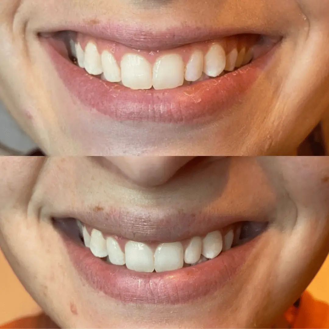 neurotoxin-before-and-after