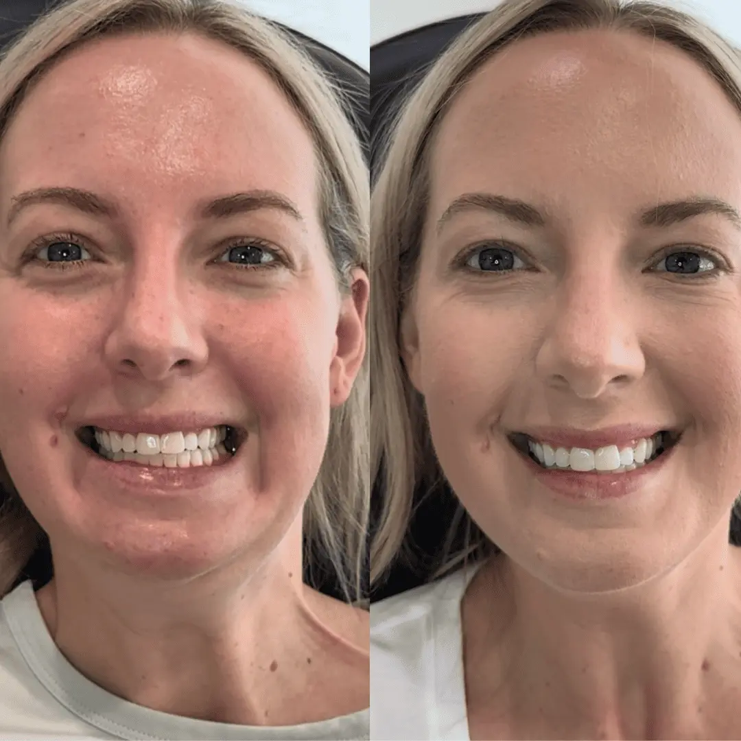 neurotoxin-before-and-after