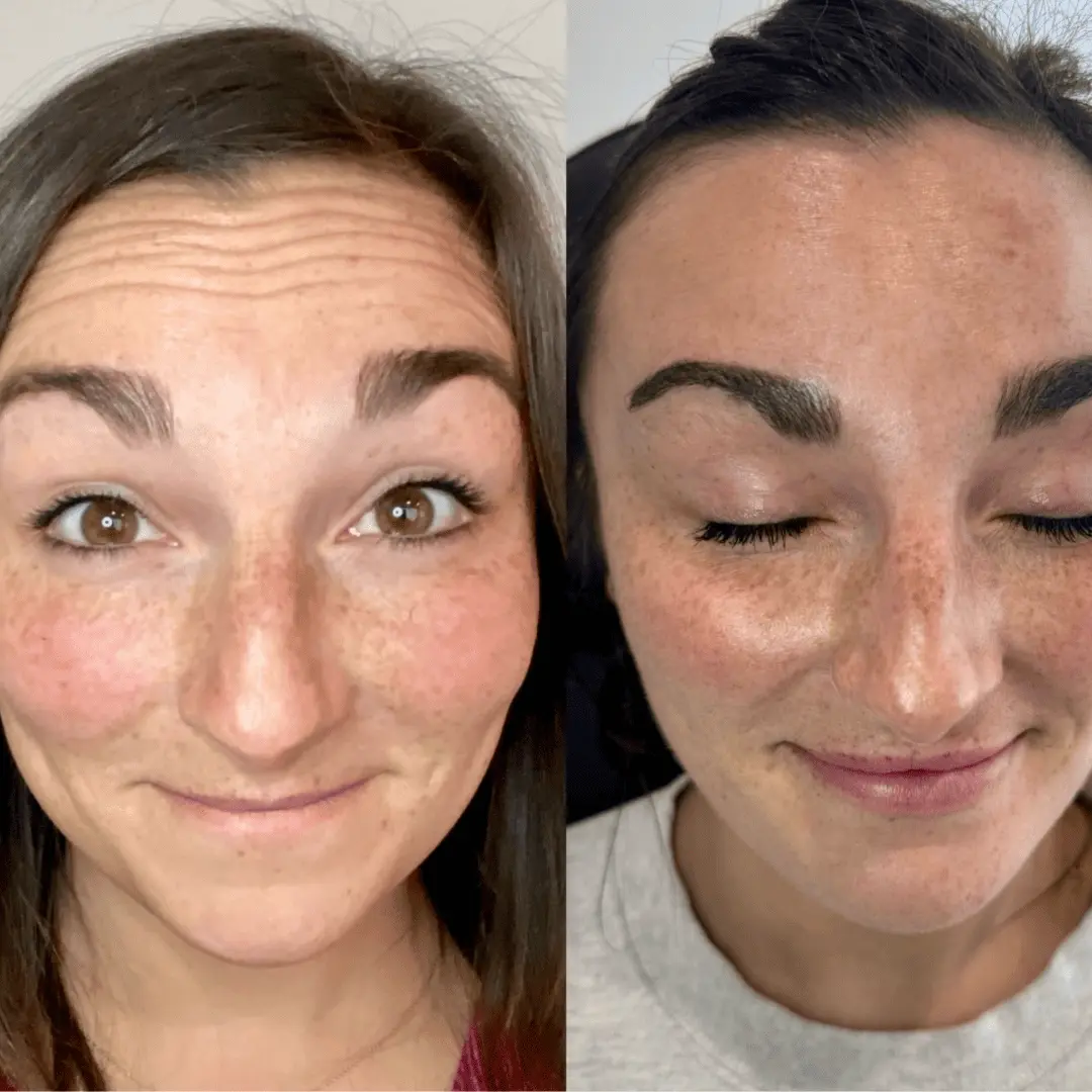 neurotoxin before and after by Refresh Medical Spa