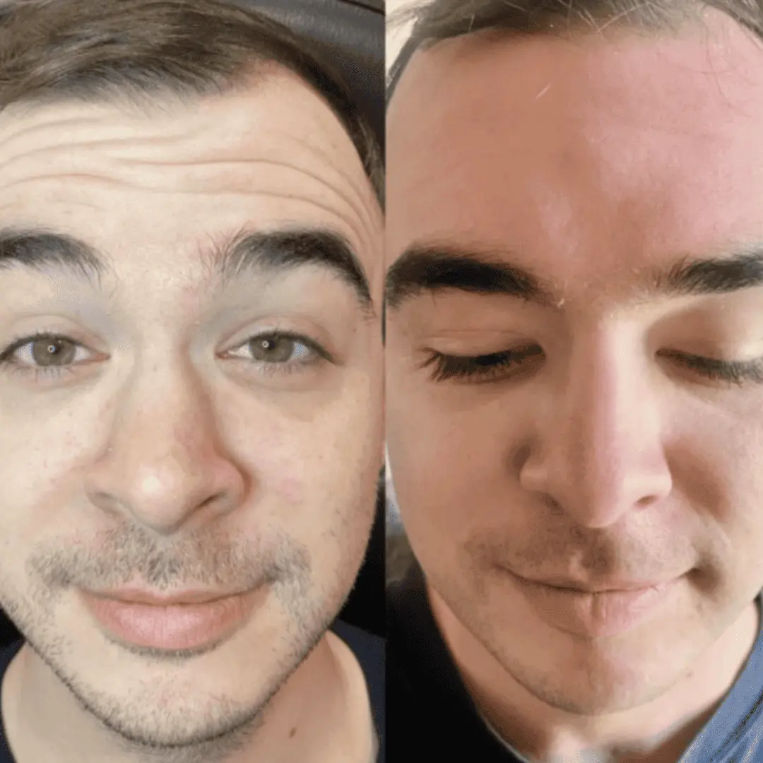neurotoxin before and after