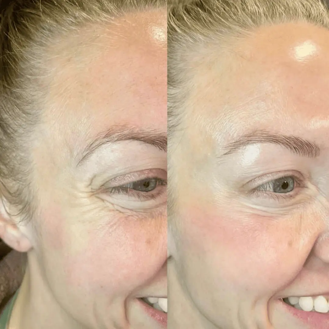 neurotoxin before and after by Refresh Medical Spa