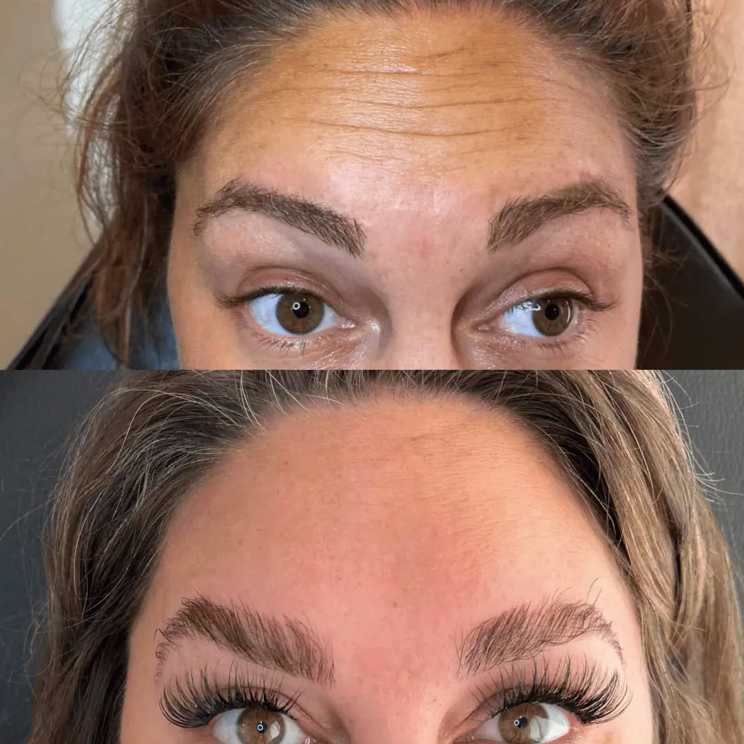 neurotoxin before and after by Refresh Medical Spa