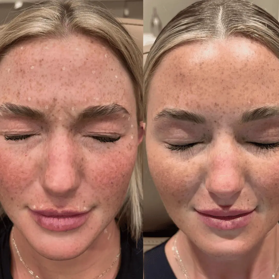 neurotoxin before and after by Refresh Medical Spa