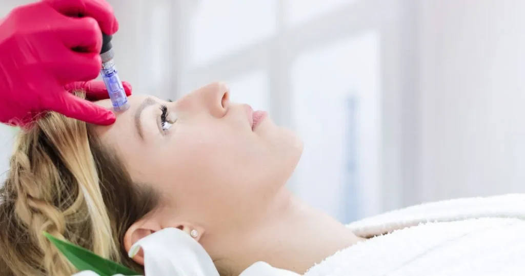 A woman receiving microneedling treatment on her forehead