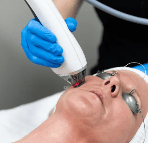 Moxi Laser Rejuvenation by Refresh Medical Spa in Overland Park, KS