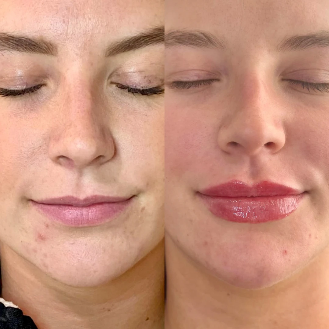 Lip Filler before after